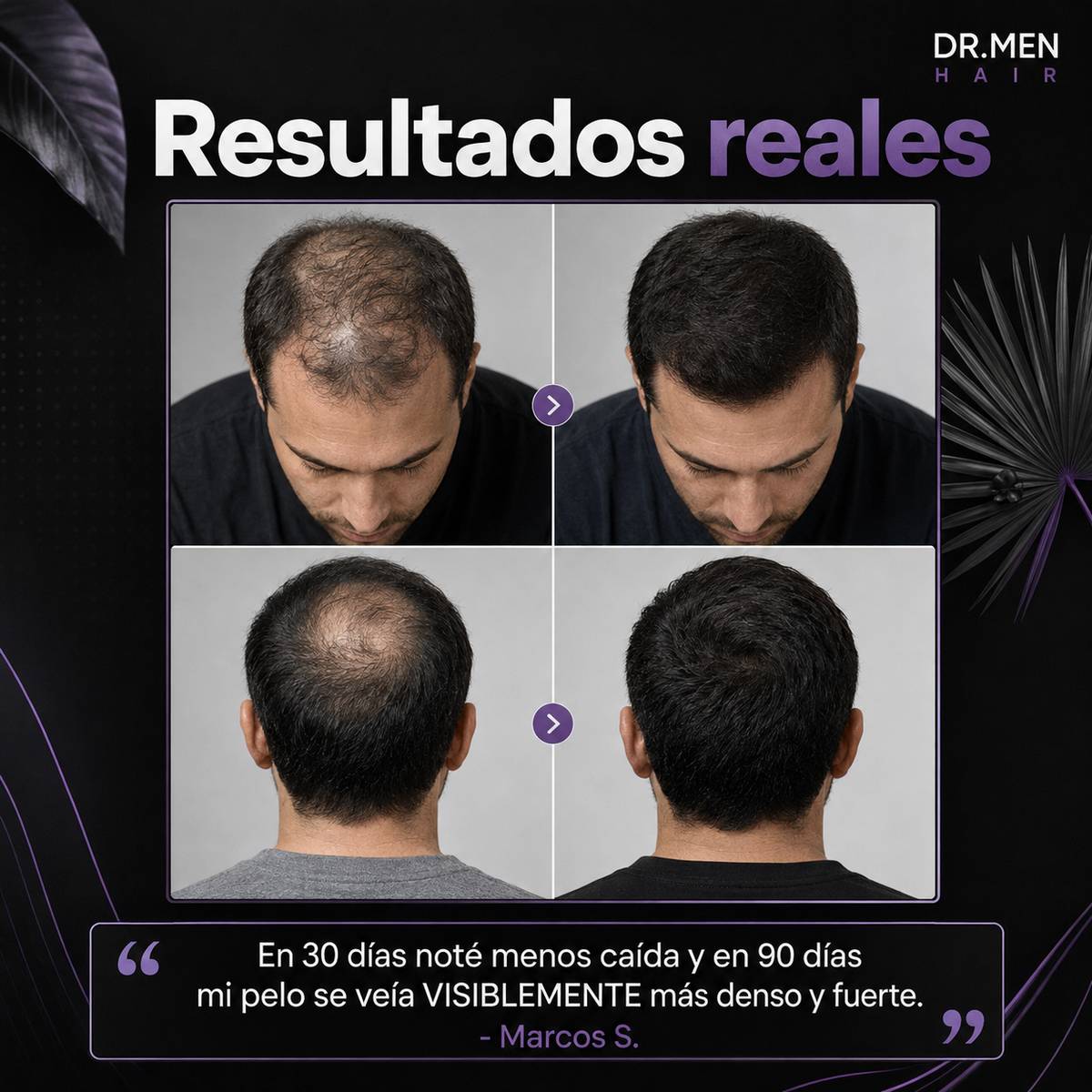 Hair Complex™ Suplemento Anticaída y Crecimiento